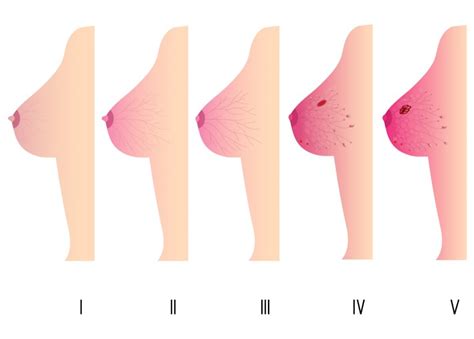 Benign lumps may be painful and cause breast. Diagnosis and Staging of Inflammatory Breast Cancer | Page ...