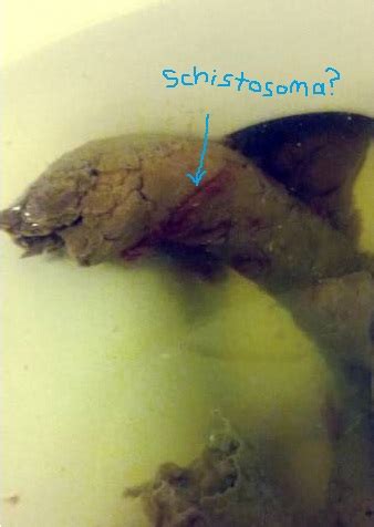 If you live in a rainy or cold climate take lots of vacations in tropical sunspots. Does anyone know if this is Schistosoma (intestinal blood ...