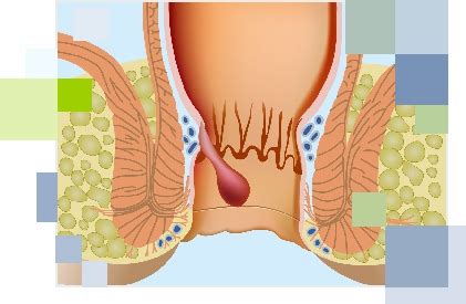 Some conditions that can be mistaken for an ingrown hair include acne, eczema, a cyst, keratosis pilaris, heat rash, impetigo, pustular psoriasis and molluscum contagiosum. WHAT IS HEMORRHOID? - Prof. Dr. Adem Dervişoğlu