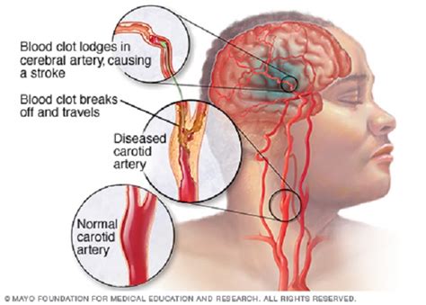 Angin ahmar atau strok ialah masalah kesihatan yang diakibatkan oleh salur darah tersumbat dan bekalan darah ke sebahagian otak diganggu. Doa dan Petua Elak Terkena Angin Ahmar/Stroke | islam ...