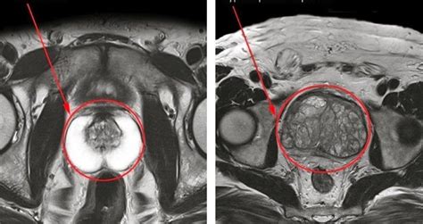 Voici comment rétrécir naturellement une prostate ... 9 Remèdes ...