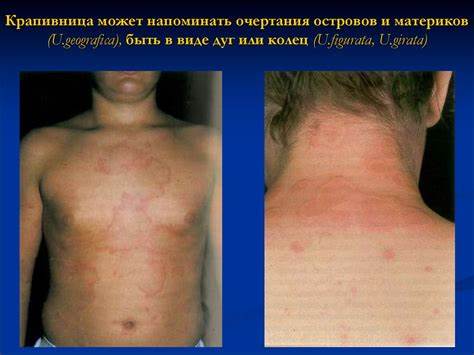 Диета отек квинке крапивница Крапивница. Отек Квинке. Гастроинтестинальный синдром - презентация онлайн Крапивница. Отек Квинке. Гастроинтестинальный синдром - презентация онлайн Диета отек квинке крапивница