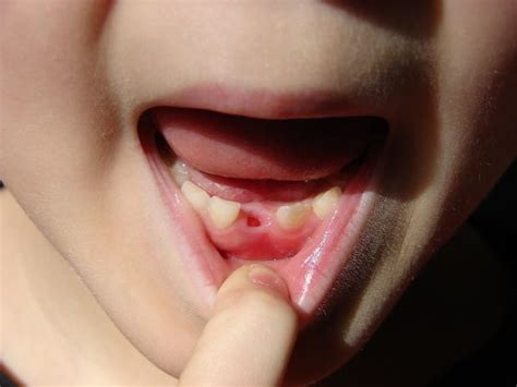 Read can you super glue a broken tooth? Doctors Are Now Warning Parents To Keep Their Children's ...