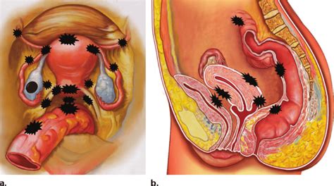 Interactive video showing normal female pelvic anatomy as seen by laparoscopy. Drawings of the female pelvic anatomy in the axial (a) and ...