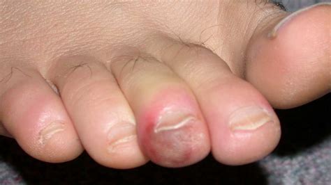 About 37% of americans have received one dose so far, and. Dermatologists link swollen, discolored toes to COVID-19 exposure | WOAI