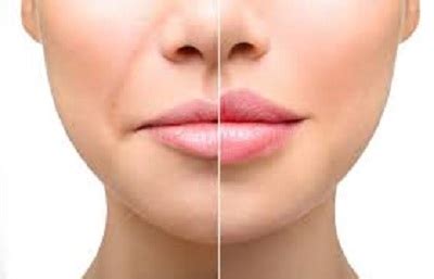 Lip lift : Le lifting des lèvres (lèvre supérieure) en détails