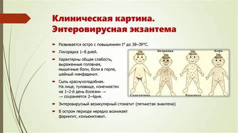 Энтеровирусные инфекции - презентация онлайн Картинка - Энтеровирусные инфекции - презентация онлайн