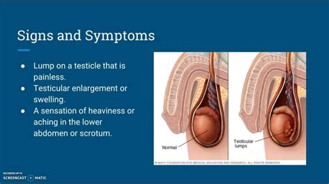 His cancer had spread to his lungs, stomach and brain. Testicular Cancer- Disease Investigation - YouTube