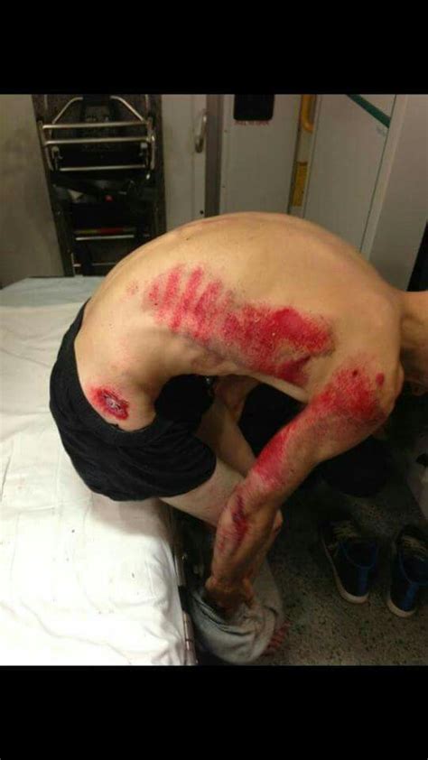 Unfortunately, road rash is one of the most common motorcycle accident injuries you can sustain in an accident. Motorbike accident injuries | T shirt and shorts, T shirt ...
