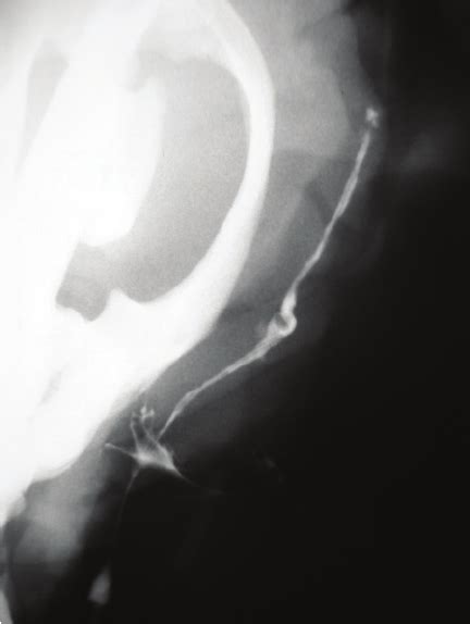 (parotid duct labeled at center left.) the parotid duct or stensen duct is a duct and the route that saliva takes from the major salivary gland, the parotid gland, into the mouth.1. Sialogram showing partial obstruction of the right parotid ...