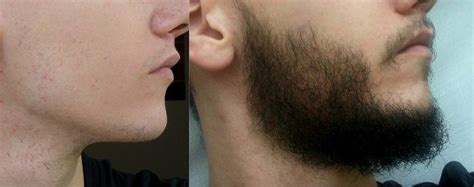 We did not find results for: The Minoxidil Beard: How to Use Rogaine to Thicken Your ...