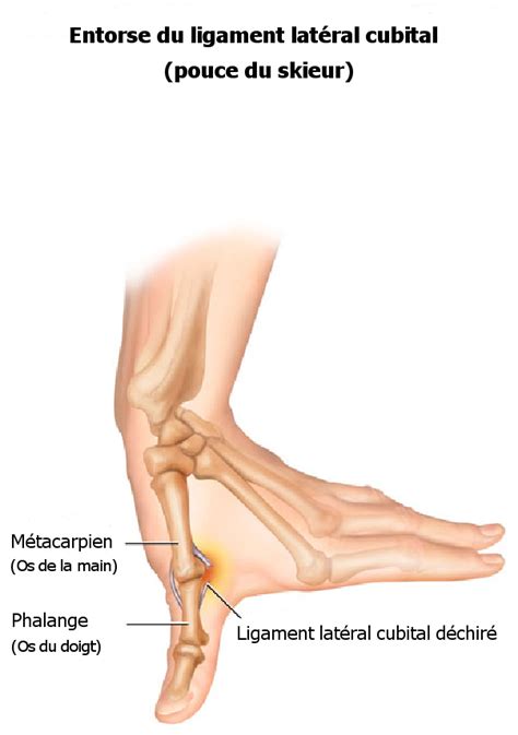 Sa terminaison aponévrotique se fait sur le bord ulnaire de la partie complications. Action Sport Physio: Le pouce du skieur