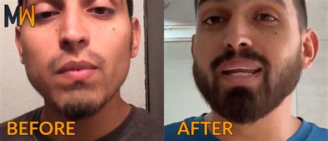 It's difficult to say whether the results after a similar trial would be exactly the same. Minoxidil Beard - Magnum Workshop