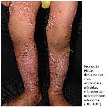 A psoríase é uma doença inflamatória da pele e não tem cura, mas o tratamento pode oferecer controle ou, pelo menos, alívio a psoríase pustulosa pode afetar todo o corpo ou afetar regiões Psoríase pustulosa da infância: relato de caso