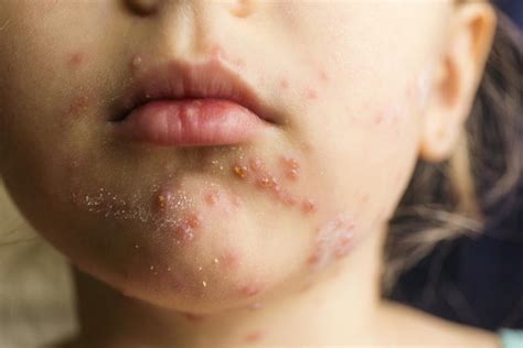 The foods you think are healthy, may be the ones causing the rash on your face. Skin rash: 68 pictures, causes, and treatments