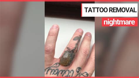 This client did 2 treatments with us (sorry we don't have a photo of the progress before the don't live with tattoos you don't love! Huge blister develops after laser tattoo removal | SWNS TV ...