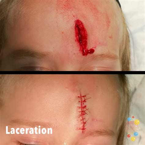Lacerations - Skin Deep
