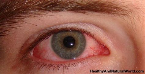 Find out how to treat cat injuries and prevent them from happening. Home Remedies for Eye Infection That Actually Work