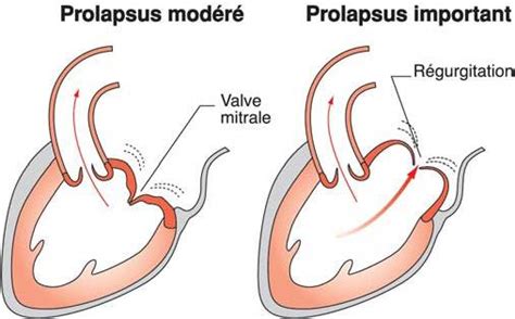 La valve tricuspide entre l'atrium (ou oreillette). Prolapsus valve mitrale - Carabiens le Forum