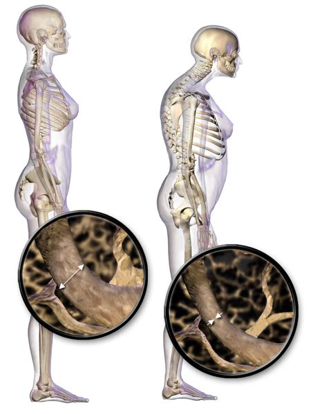 Cystická fibróza je autozomálne recesívne dedičné ochorenie, ktoré vzniká mutáciou génu pre cftr na dlhom ramienku 7. File:Blausen 0686 Osteoporosis 01.png - Wikimedia Commons