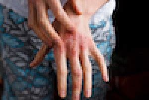Use them for web design, mobile apps, or presentations. NACE Online - Addressing Type 2 Inflammation in Atopic ...
