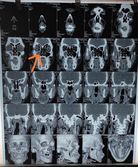 Most fungi are not dangerous, but some types can be harmful to health. 'Black' fungal disease kills nine in Ahmedabad, causes ...