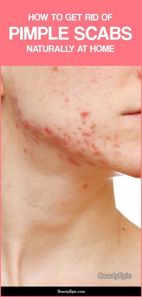 See full list on wikihow.com How to Get Rid of Pimple/Acne Scabs Naturally | How to get ...