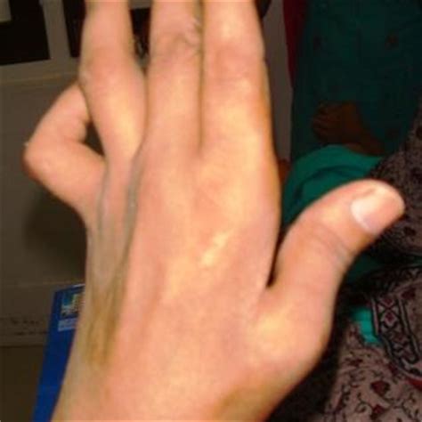 Mengompres tangan kanan mampu untuk. Bila dah kena penyakit gout... ϟ acaPAWИ7:blog