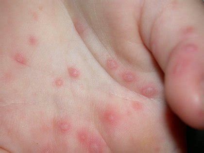 More often than you'd think. Hand Foot and Mouth Disease Pictures, Symptoms, Causes and ...