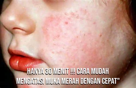 Buka penutup dan secara otomatis akan menarik produk ke dalam. Hanya 30 Menit !!! Cara Mudah Mengatasi Muka Merah Dengan ...