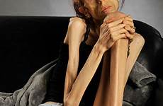 farrokh anorexia woman rachael anorexic california person now battle over who story today describes long