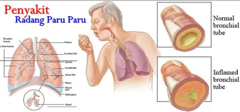 Menjaga kesehatan paru merupakan salah satu hal yang paling penting dalam mengoptimalkan kesehatan tubuh. Sihat Itu Nikmat - HEALTH | BISNES | FAMILY: PNEUMONIA DAN ...