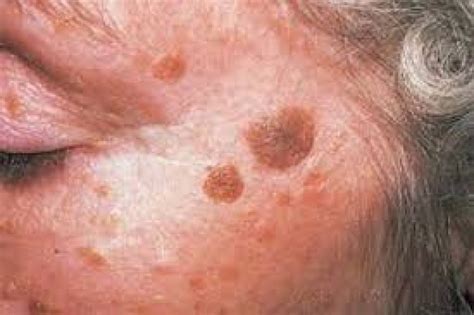 Normalmente, il sistema immunitario va a colpire elementi il lupus è una malattia autoimmune che prevede l'attivazione del sistema immunitario contro il corpo se avete notato la comparsa di macchie rosse sulla pelle senza prurito , vi starete certamente chiedendo. Sole e tumori, si abbassa l'età della malattia, rischio ...