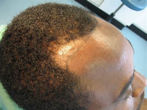 Black hair transplant update 15 months. Afro hair transplant Westminster clinic