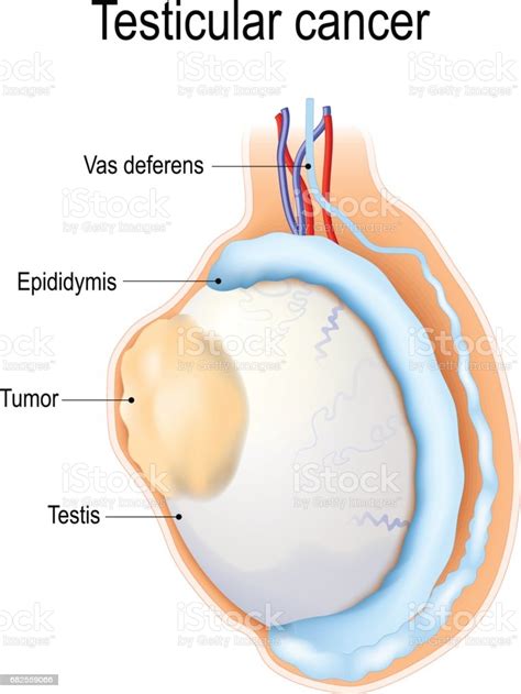 There are several different symptoms that you can look for to identify whether you may have testicular cancer. Testicular Cancer Stock Vector Art & More Images of ...