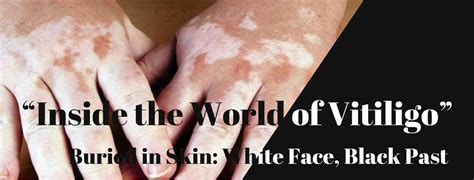 Tabish khan to buddha hai inzamam shocking statement and a perfect reply. Vitiligo in Kashmir |Causes, Treatment and Symptoms