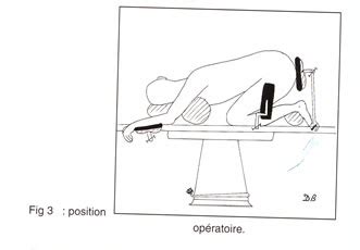 L'hernie discale est souvent en position paramédiane vers la zone critique. Campus numérique de neurochirurgie