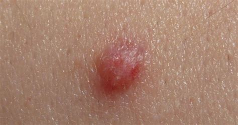O hpv é um vírus que atinge a pele e as mucosas, causando verrugas e lesões no sistema reprodutor. HPV: o que é e como se transmite? - Médico Responde