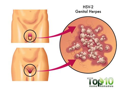 Herpes is a contagious viral infection that affects more females than males. Home Remedies for Genital Herpes | Top 10 Home Remedies