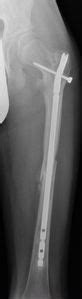 OSTEOTOMIA DEROTATIVA E VARIZZANTE CON CHIODO ...