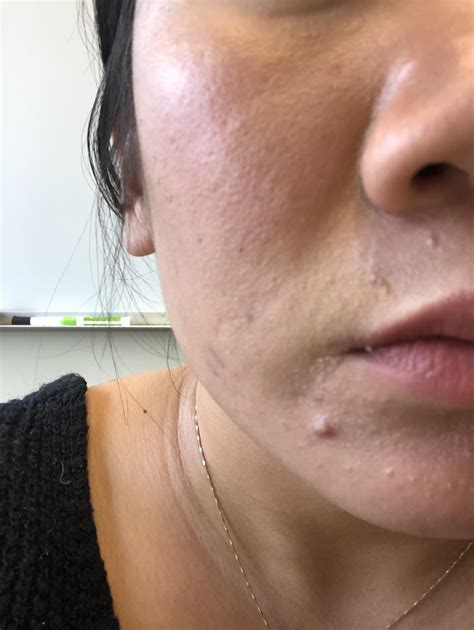 Eclipse micropen® elite can improve the appearance of uneven skin tone, acne scars, and traumatic scars. I've used The Ordinary peel, Dennis Gross peels and ...