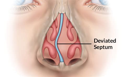 In this article, we shall look at the openings into the nasal cavity. Deviated Septum St. Louis, MO | Deviated Septum Surgery ...