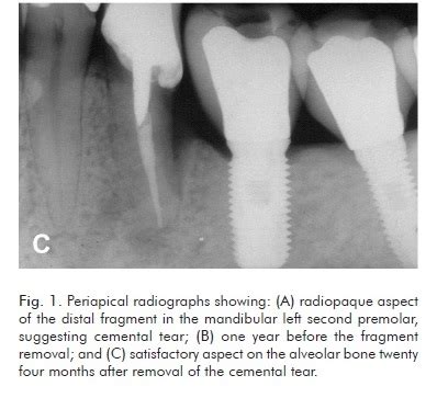 Jun 25, 2015 · metal ii. Cemental tear: a case report with nonsurgical periodontal ...