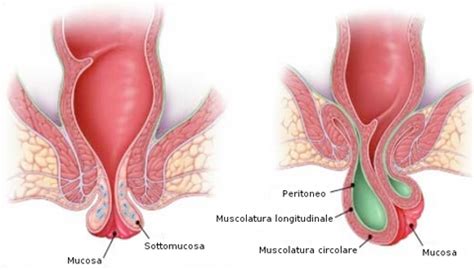 Watch anale qualen online on youporn.com. Il prolasso rettale - coloproctologia, ernie addominali ...