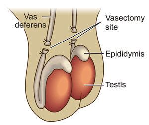 Maybe you would like to learn more about one of these? Vasectomy - Cost, Recovery, and Effectiveness from Urology San Antonio