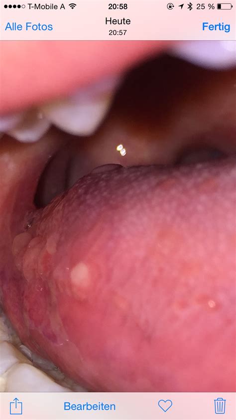 Meist ist mangelnde hygiene der grund für pickel auf der zunge. Bläschen hinten auf der Zunge? (Gesundheit, betrogen ...