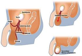 It is a small extension of the peritoneal cavity which lies between the uterus and the rectum. Orchiopexy - Wikipedia