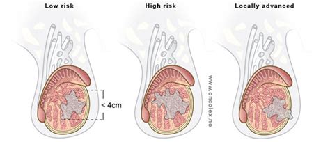 Some early cancers may have signs and symptoms that can be noticed, but that's not always the case. Oncolex Utskriftsvennlig versjon