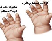 Check spelling or type a new query. ژنتیک؛علم نوین | سندروم داون