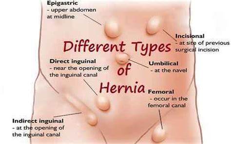 Since some types of abdominal hernias can turn into serious, immediate treatment may be necessary. Hernia Surgeon in Navi Mumbai, Hernia Surgeon Mumbai - Dr Sujit Prasad